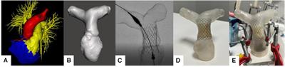 Optimizing percutaneous pulmonary valve implantation with patient-specific 3D-printed pulmonary artery models and hemodynamic assessment